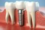 Restore Your Smile with Dental Implants in Mumbai