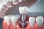 Get Permanent Dental Implants in Mumbai Today