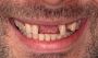 Affordable Tooth Replacement Solutions | Dental ImplantS
