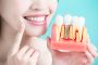 Regain Your Smile with Implant-Supported Dentures Townsville