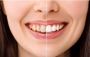 Brighten Your Smile with Teeth Whitening in Mumbai