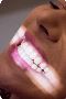 Get a Brighter Smile That Lasts Longer