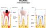 Say Goodbye to Tooth Pain: Discover the Benefits of Root Can