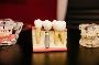 Find the Dental Implants Cost - Dental Costs Australia