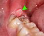 Wisdom Teeth Pain Symptoms