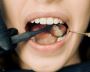 Dental Veneers Philadelphia