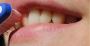 The Best Dental Implants in Sydney for Enhanced Oral Health