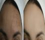 Your Trusted Skin Clinic in Coimbatore – Advanced Treatments