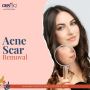 Acne Scar Treatment in Hyderabad | Dermiq Clinic
