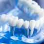 Dental Implants - How Teeth Replacement Works