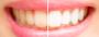 Get The Pearly White Teeth You Want In Your Budget 