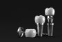 Anchors to Your Smile: Dental Implant