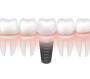 Restore Your Smile with Dental Bridges in Smith Lake, AL