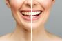 Teeth Whitening Sunset Hills - Achieve a Dazzling Smile!