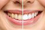 Teeth Whitening Somerset KY - Brighten Your Smile Safely!