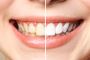 Restore Brightness with Teeth Whitening Raleigh NC