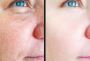 Laser Hair Removal In Toronto | Distill Laser Clinic