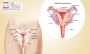 Best Endometrial Cancer Treatment in Manipal