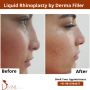 RHINOPLASTY – NOSE PLASTIC SURGERY IN DELHI