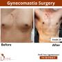 Gynecomastia Surgery & Male Breast Reduction in India