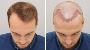 Hair Transplant Surgery Cost: Affordable