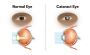 Cataract Eye Surgery in Delhi - Dr Anisha Gupta