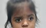 Squint Eye Surgery in Delhi - Dr Anisha Gupta