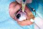 Retinal Hemorrhage – Symptoms, Causes and Treatment
