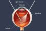 How Long Does It Take to Recover from Retina Surgery?