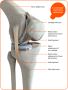 Partial Knee Replacement in Mumbai