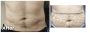 Liposuction in Lahore