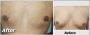Gynecomastia Surgery In Lahore