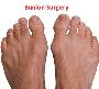 Bunion Surgery Dubai