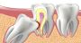 Painless Wisdom Tooth Removal in Thane | Expert Extraction