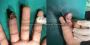 Best Hand Surgeon Delhi - Dr. Deepak Rathore Best Hand Surgeon Delhi - Dr. Deepak Rathore