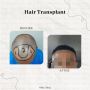 Dr Ditta Hair Transplants- Expert Hair Transplant for Women 
