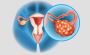 Effective PCOD Treatment in India: Methods, Clinics & Costs
