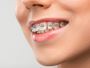 Best Orthodontic Braces in Ghaziabad – Dr. Khan Clinic