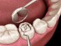 Dental Fillings in Khora Ghaziabad – Expert Tooth Care