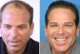 Restore Your Confidence with Top Hair Loss Treatment in Wash