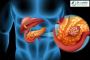 Best Pancreatic Cancer Surgery in Bangalore - Dr. Lohith U