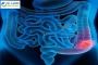 Expert Colon Cancer Treatment in Sarjapur Road