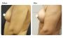 Breast Augmentation Surgery Cost in India by Dr. Priya Bansa