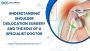 Understanding Shoulder Dislocation Surgery and the Role of a