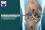 Are you looking for the cost of knee replacement in Ahmedaba