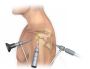 Robotic Total Knee Replacement