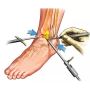 Arthroscopic Knee Surgery