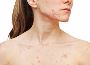 Acne Scar