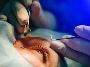 Cataract Surgery San Antonio