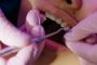 Get Straight Teeth with Braces in Charlotte, NC